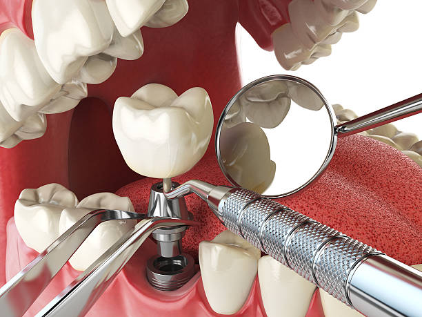 Best Emergency Dentist for Lost Fillings or Crowns in Paia, HI